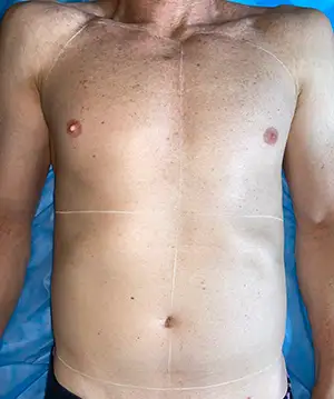 mens hair removal