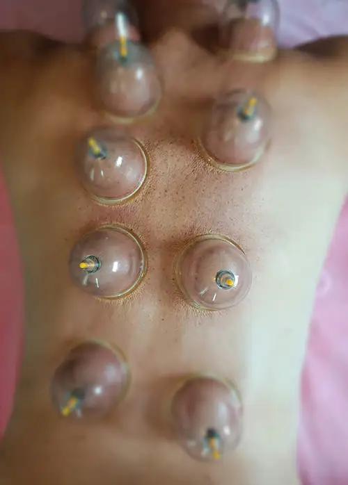 cupping therapy clinic
