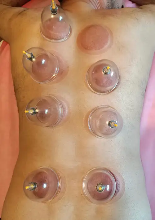 cupping therapy clinic