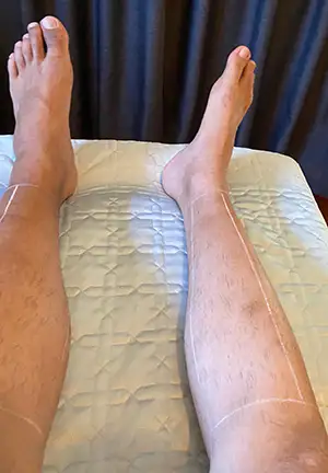 laser hair removal on legs