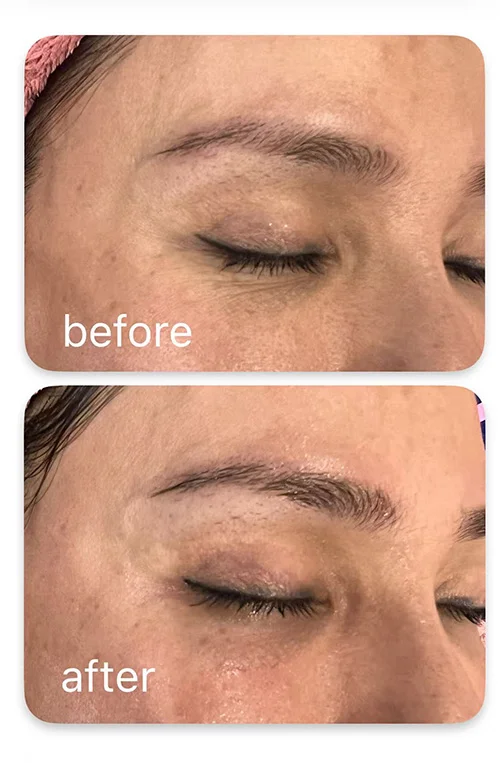 non surgical eye lift non surgical eye lift