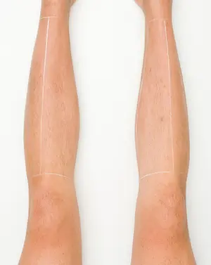 laser hair removal on legs